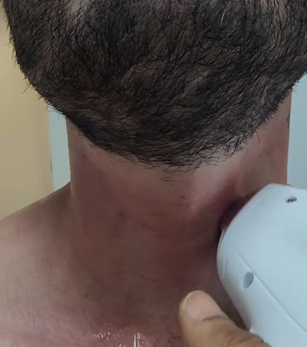 הסרת שיער בלייזר נתניה: מדריך לפני שמתחילים